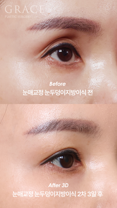 The Key to Improving Sunken Eyelids with Orbital Fat Grafting Is Placement, Not Volume image 7