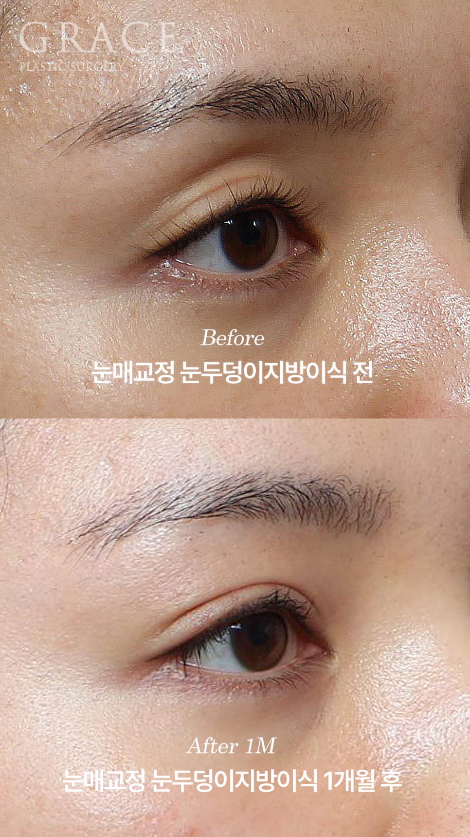 Why Choose Upper Eyelid Fat Grafting Instead of Eye-Hollow Filler? image 8