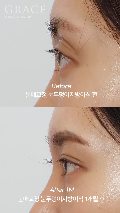겹쌍꺼풀&middot;비대칭 눈 교정｜패인눈 함몰은 눈꺼풀 지방이식 관련 이미지 6