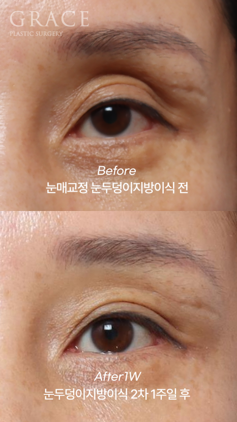 눈두덩이지방이식 2차 이식(리터치) 마취&지방채취 부위 등 관련 이미지 2