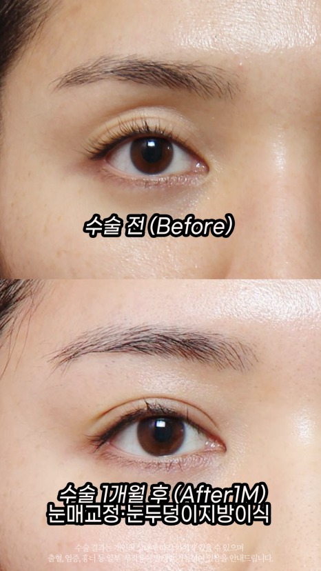 Eyelid Fat Transfer (eyelid fat transfer) Grace Plastic Surgery image 2