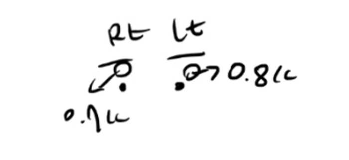 아이홀 지방이식 ‘몇 cc 넣느냐’보다 더 중요한 것은? 관련 이미지 1