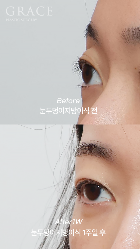 No to Frozen Fat That’s Completely Frozen! Eyelid Fat Grafting with Only Fresh Autologous Fat image 8