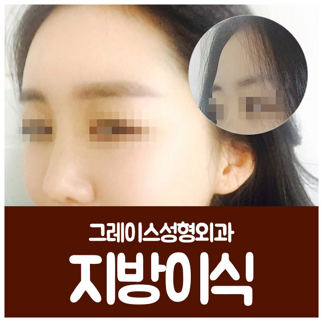얼굴지방이식으로 생기 있고 윤기나는 동안 얼굴로! 관련 이미지 5