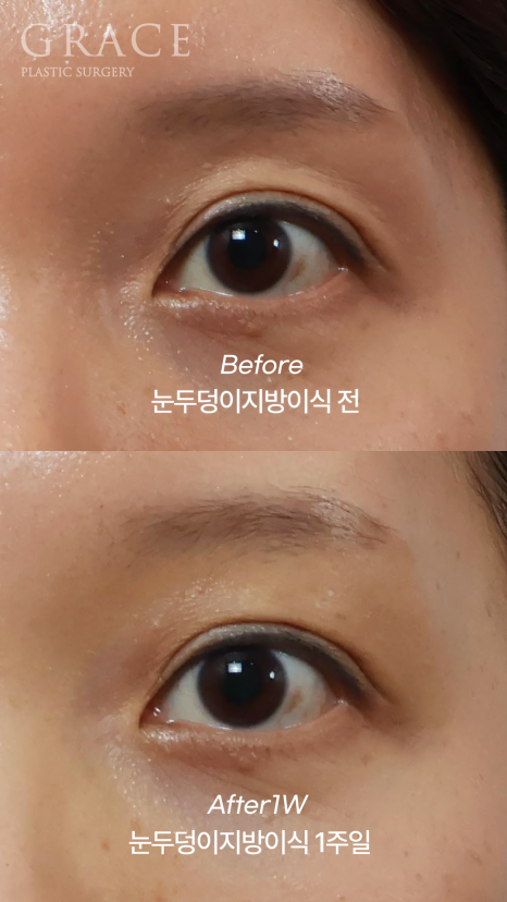 Fat Removal After Double Eyelid Surgery? Eyelid Fat Grafting After Double Eyelid Surgery Before & After image 7