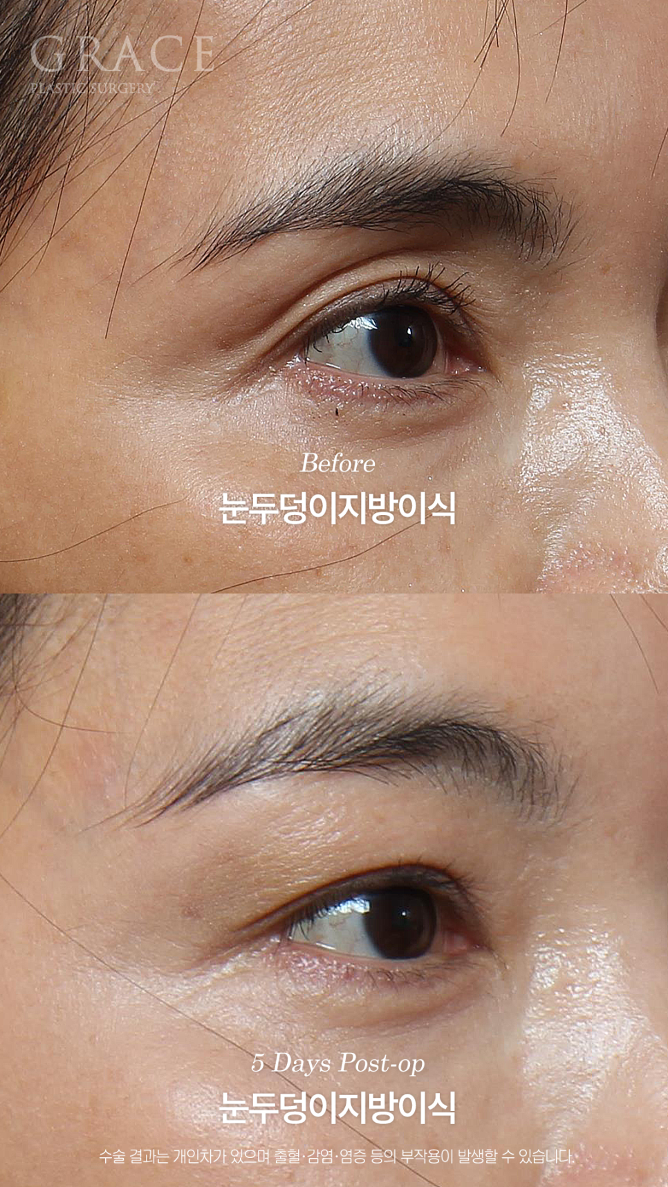 Will a Sunken Upper Eyelid Become Bumpy When You Close Your Eyes After Fat Grafting? image 5