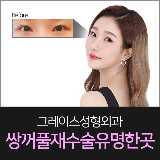 쌍꺼풀재수술유명한곳은 바로 여기지! 관련 이미지 3