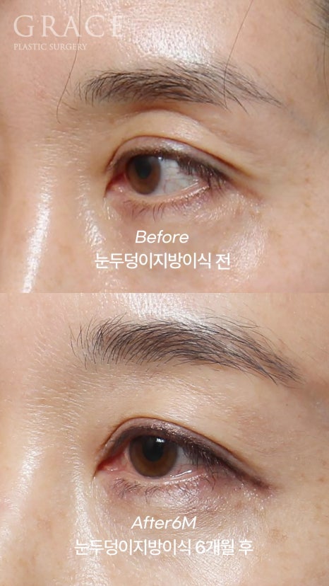 Eyebrow Hollow Fat Grafting Before and After Comparison – Gently Filling Sunken Eyes image 8