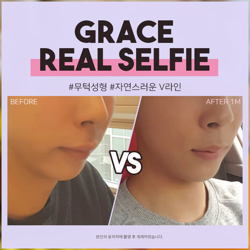 Pros and Cons of Comparing Chin Implants and Chin Fillers image 7
