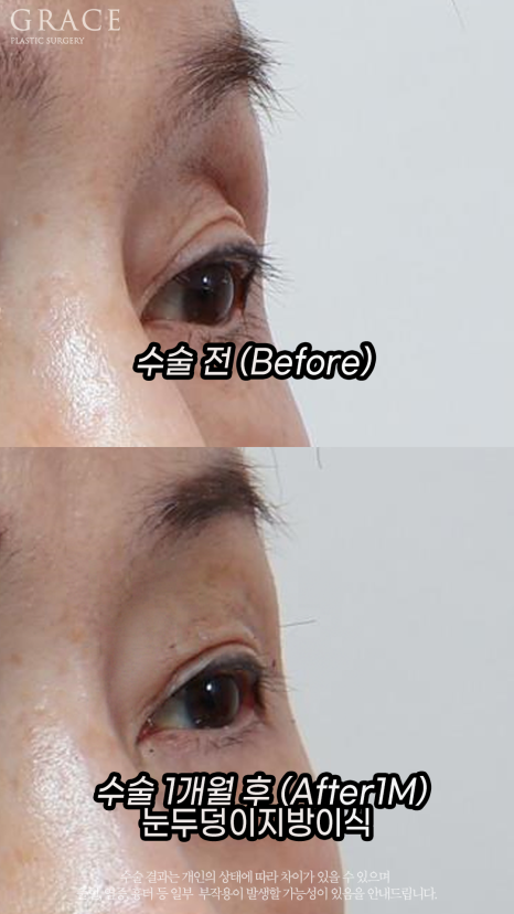 눈두덩이 지방이식으로 젊음을 되찾다: 70대, 40대 시술 전후 비교 관련 이미지 4