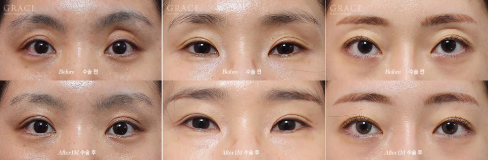 3 Things You Must Know Before Eyelid Fat Grafting image 4