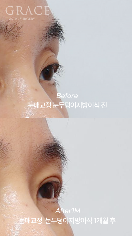 50대 절개눈매교정과 눈위지방이식 붓기는 얼마나 가나요? 관련 이미지 4