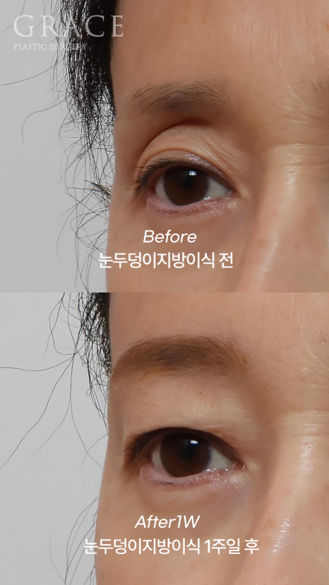 눈두덩이 지방이식 유지기간과 부작용까지 한 번에 정리 관련 이미지 3