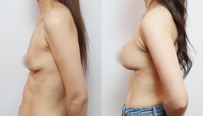 I Had Breast Augmentation for Sagging Breasts—Will It Cause Stretch Marks Too? image 5