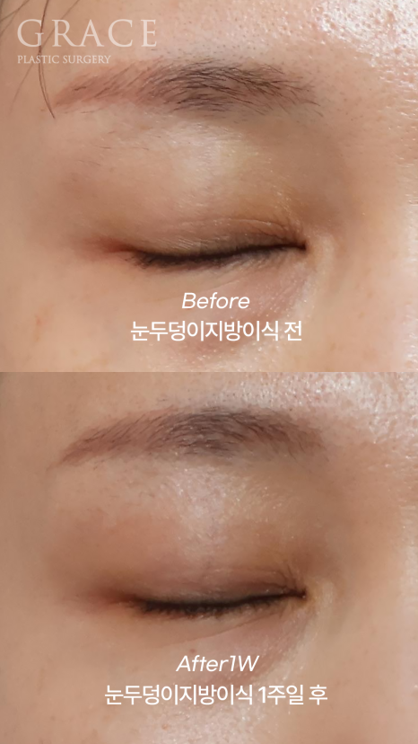 Sunken Eyelid Fat Grafting: Swelling After 1 Week Before & After image 3