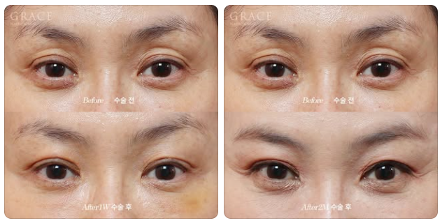 After eyelid fat grafting, do scars remain when you close your eyes? One week later... is this a failure? image 3