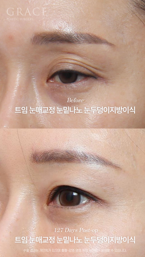 20년 전 쌍꺼풀 수술 겹쌍꺼풀에 눈두덩이 꺼짐까지? 아이홀 지방이식 재수 관련 이미지 8