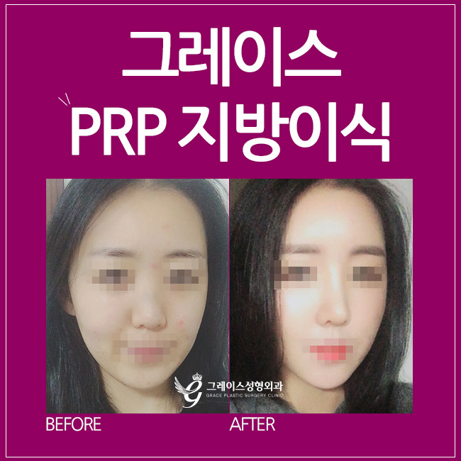 얼굴지방이식을 알아본다면? 신사역 그레이스성형외과 관련 이미지 4