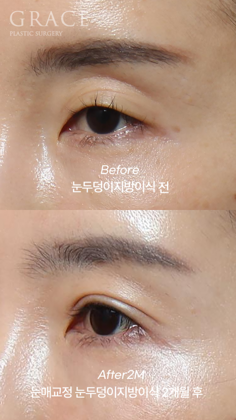 눈두덩이 지방이식 걱정만 덜기 관련 이미지 6