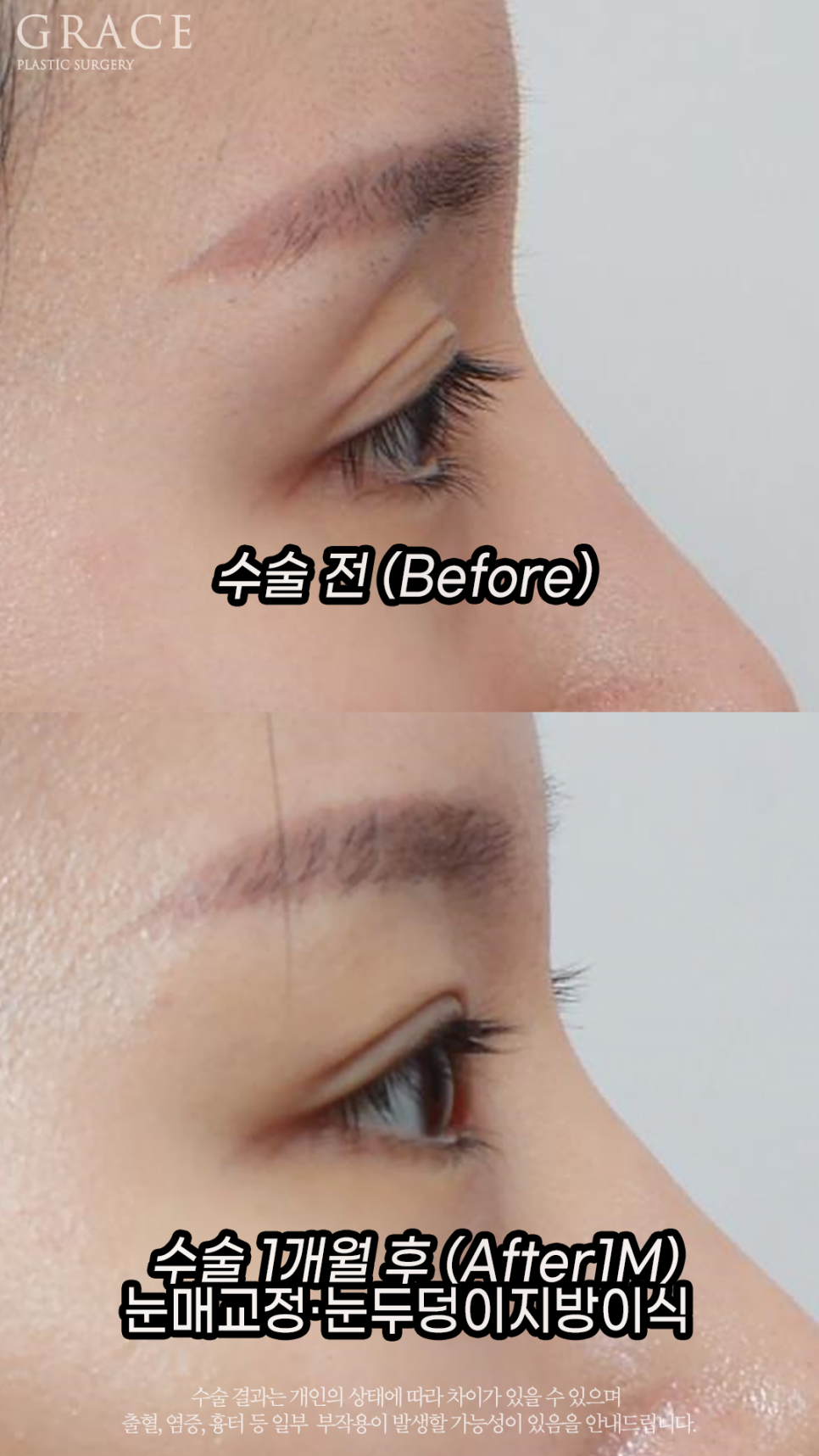 Before and After Upper Eyelid Fat Grafting for Women in Their Early 30s image 5