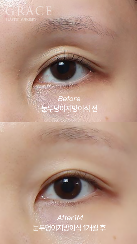 아이홀 꺼짐? 필러 말고 눈꺼풀 지방이식으로 해결했어요 (지방뭉침 없이) 관련 이미지 6