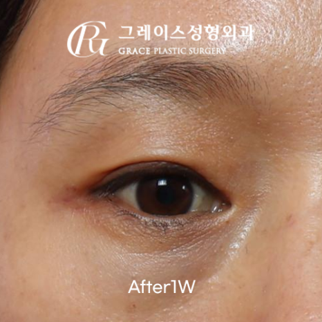 꺼진 눈 성형 1주일 붓기 보정 없이 솔직하게 보여드립니다 관련 이미지 2