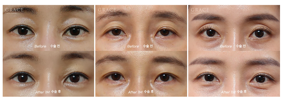 눈두덩이 지방이식 비절개 눈매교정 반드시 필요할까? (초이칼럼) 관련 이미지 8