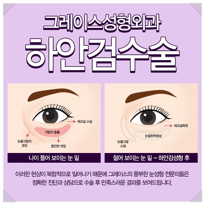 눈 밑 처짐 해결, 하안검수술후기 관련 이미지 3