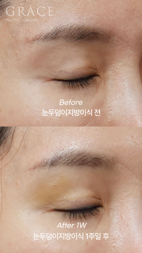 One-Week Changes After Eyelid Fat Grafting: Sunken Eye Hollows Regain Volume image 6