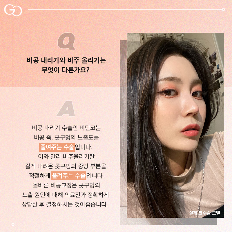 구축코 짧아진 코, 관련 이미지 3