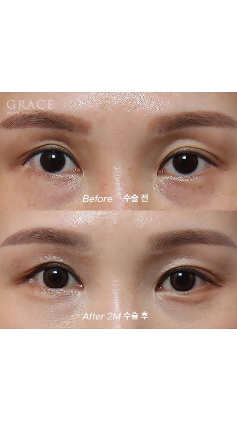 Eyebrow Hollow Fat Grafting Before and After Comparison – Gently Filling Sunken Eyes image 6