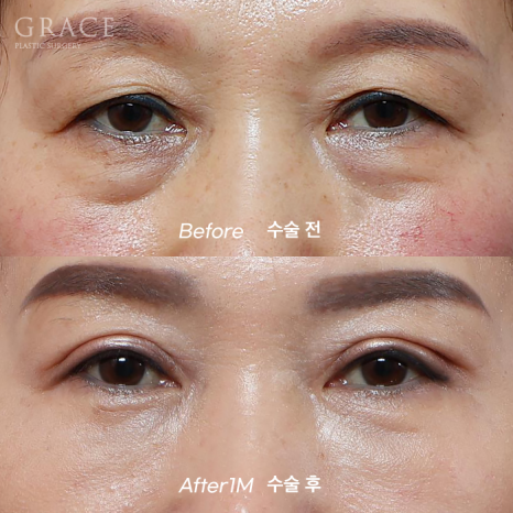 Side Effects of Under-Eye Fat Repositioning? Common Traits of People Who Say It Went Wrong image 11