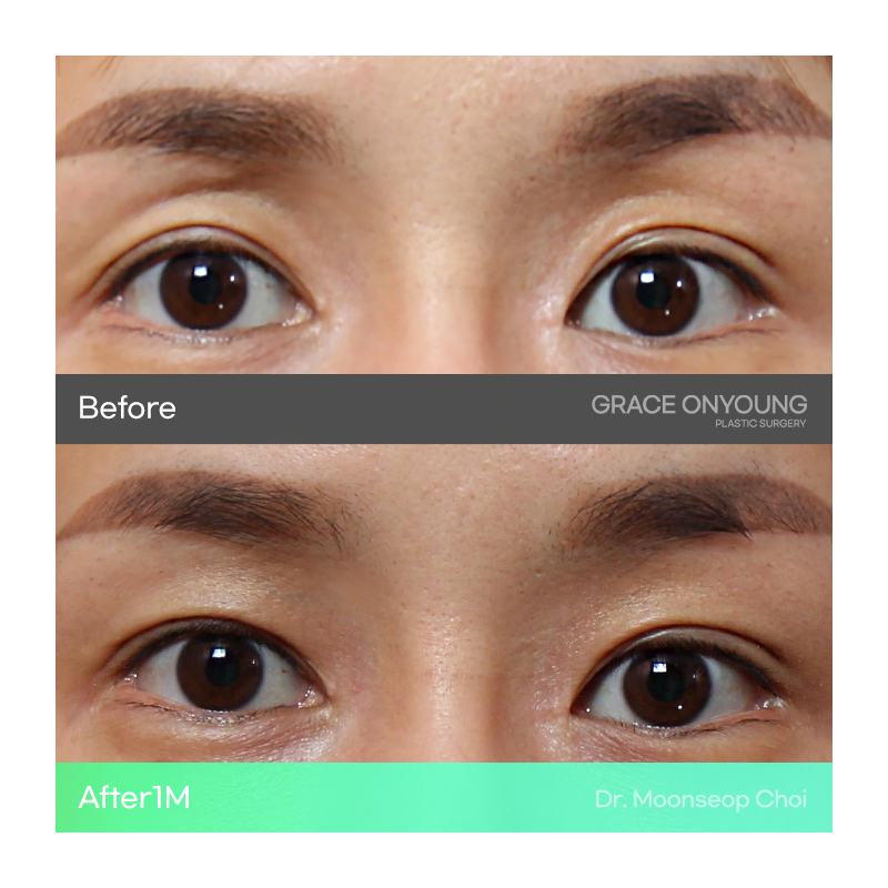 Shocked After Hearing That My Hollow Eyes and Sunken Eye Holes Were Severe? Upper Eyelid Fat Grafting image 6