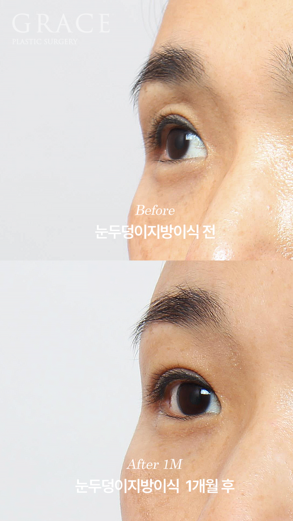 그레이스성형외과 눈두덩이 꺼짐 지방이식 전후 비교 관련 이미지 4