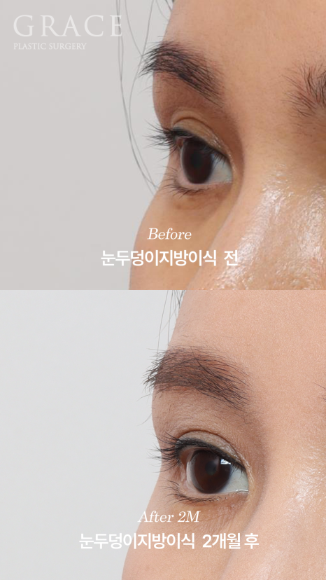 Will Swelling After Eyelid Fat Grafting Last a Long Time... Is It Really True? image 5