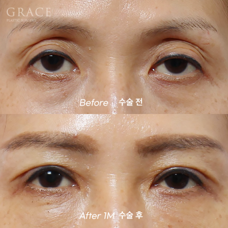 Concerns About Swelling and Side Effects After “Eye Hollow Fat Grafting” Surgery in the Eye Socket Area for People in Their 60s image 17