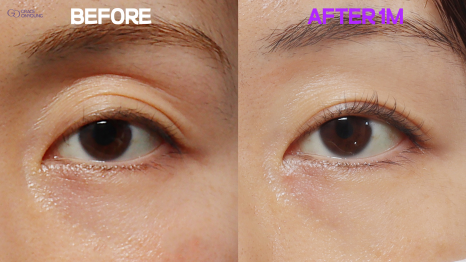 Revealing Why Fat Graft Is Placed into the Orbital Fat in the Upper Eyelid image 10