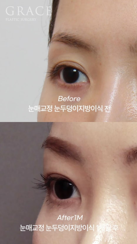 Eyebrow Hollow Fat Grafting Before and After Comparison – Gently Filling Sunken Eyes image 18