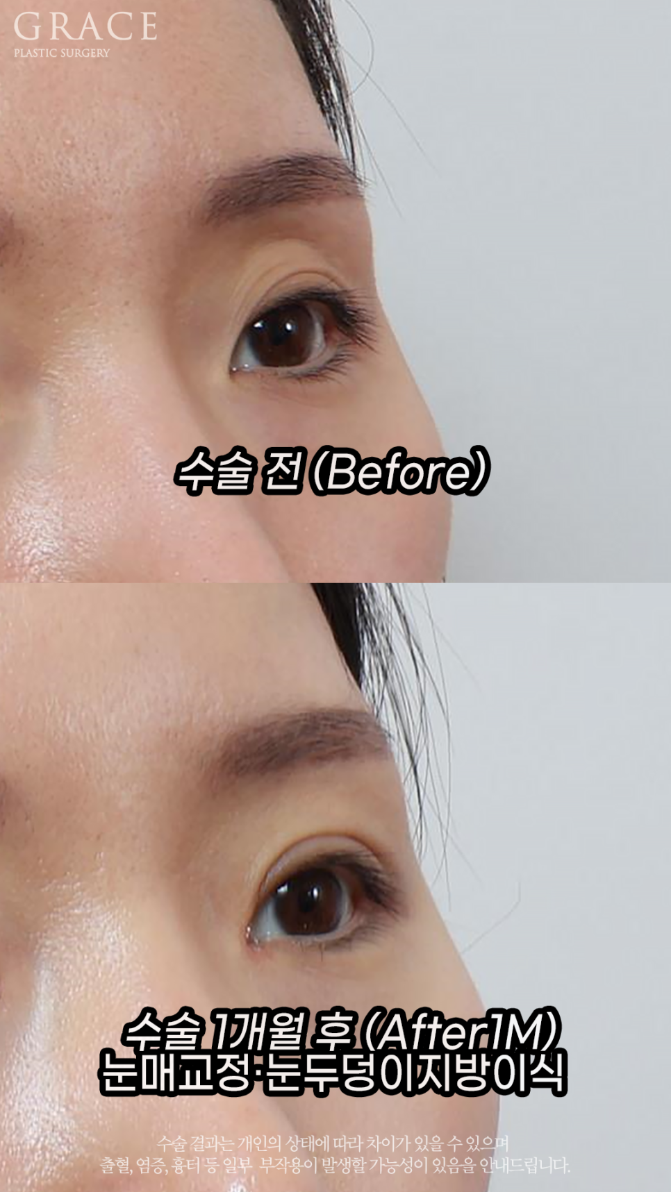 Before and After Upper Eyelid Fat Grafting for Women in Their Early 30s image 4