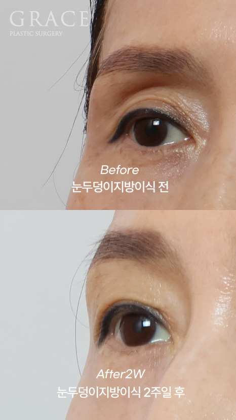 60대 중년 눈두덩이 안와지방이식 1cc 전후 관련 이미지 6