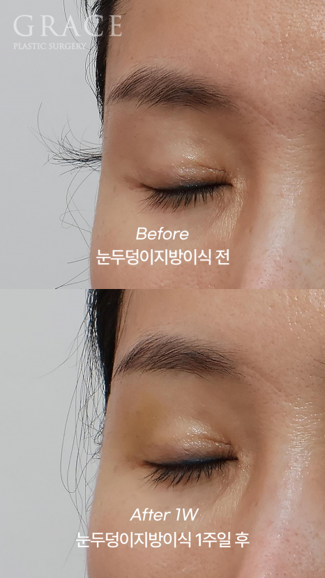 One-Week Changes After Eyelid Fat Grafting: Sunken Eye Hollows Regain Volume image 3