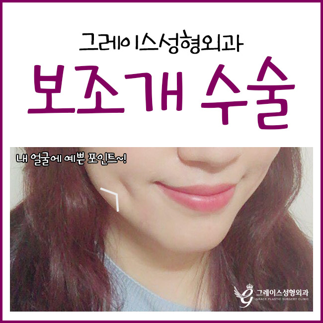보조개수술후기, 매력적인 이미지 변신 관련 이미지 5