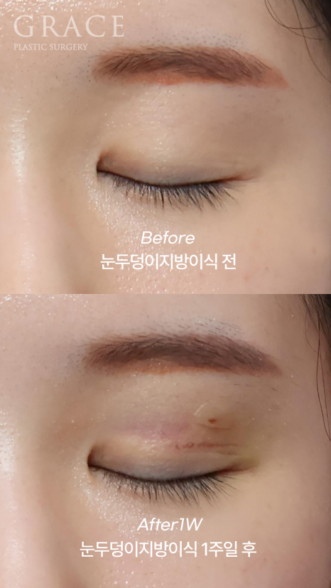 아이홀 꺼짐은 MZ도 예외 없다 눈두덩이 지방이식으로 짝눈교정 관련 이미지 1