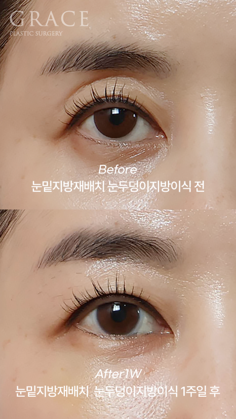 Under-Eye Fat Repositioning & Eyelid Fat Grafting: Double the Swelling? Before and After 1 Week image 3