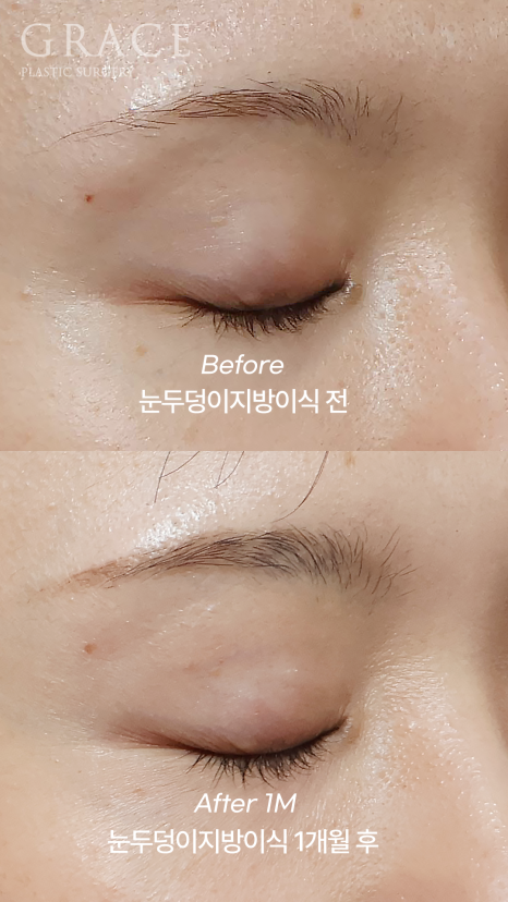 돌출눈·눈위 꺼짐으로 고생하는 사람이라면? 관련 이미지 4