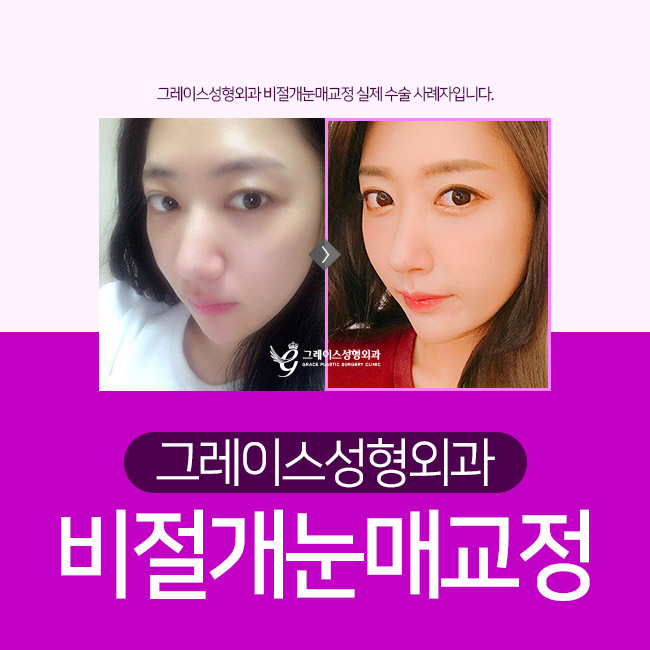 졸린 눈 탈출! 자연유착쌍꺼풀과 비절개눈매교정으로 관련 이미지 3
