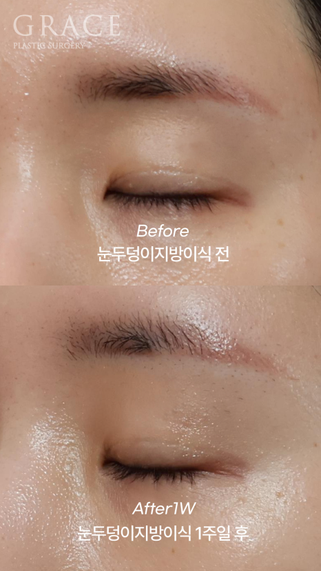 눈 감았을 때 울퉁불퉁? 실제 눈두덩이지방이식 전후 관련 이미지 10