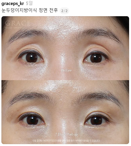 눈꺼풀지 방이식 심하게 꺼진 40대 눈 위 7일 만에 얼마나 달라졌을까? (그레이스성형외과 눈두덩이지방이식) 관련 이미지 1
