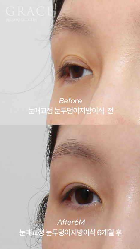 30대 눈꺼풀 지방이식 재꺼짐? 부작용? 6개월 후 관련 이미지 5