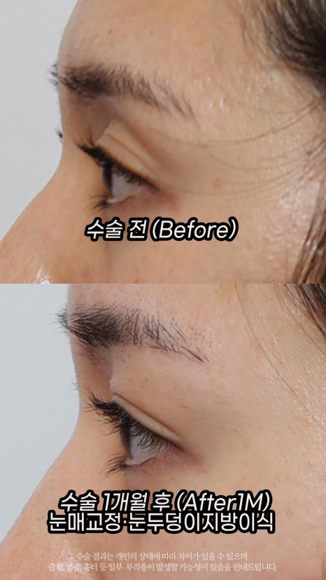 Eyelid Fat Transfer (eyelid fat transfer) Grace Plastic Surgery image 1